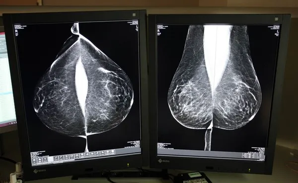 MAMOGRAFIA