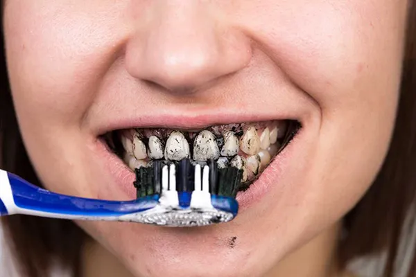 blanqueamiento-dental-con-carbon-activado