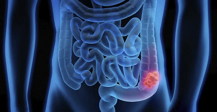 CANCER COLORECTAL