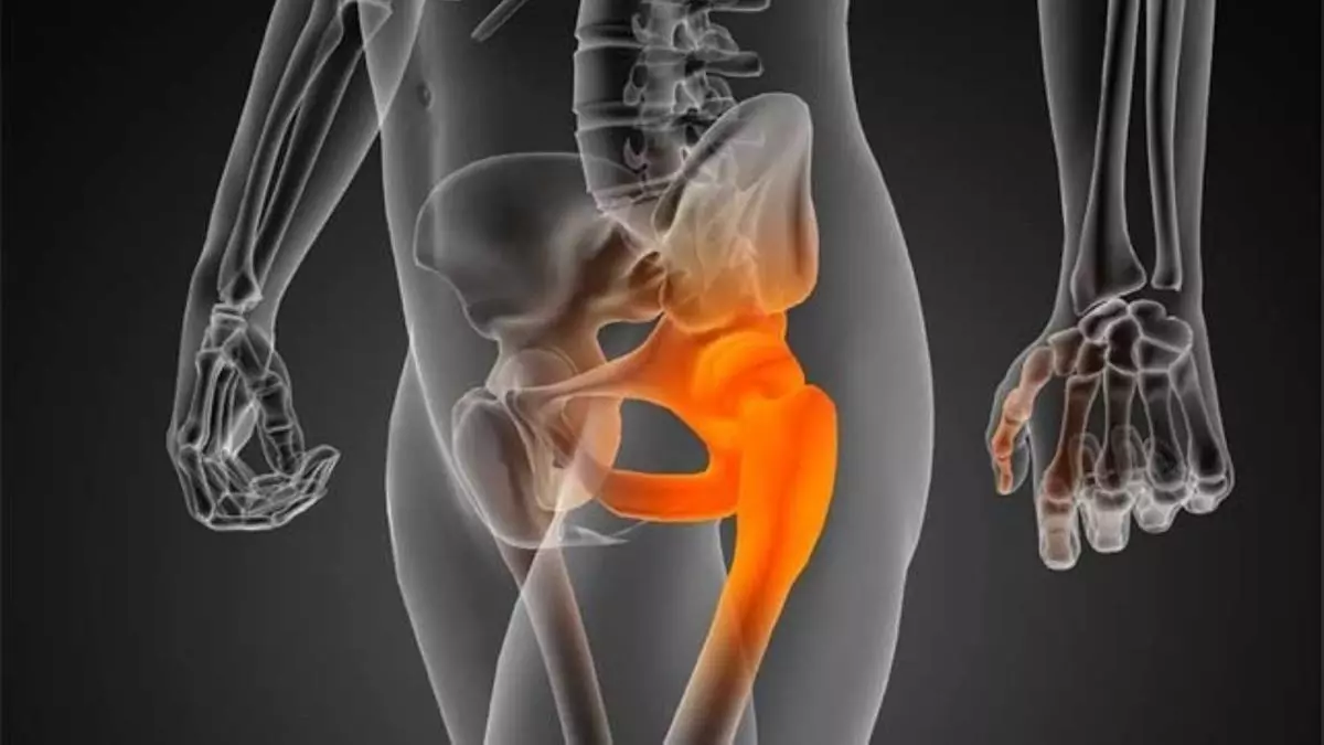 Enfermedad-de-Perthes